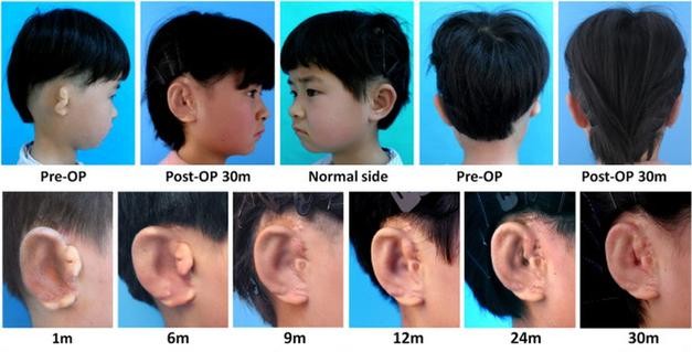 Nowe uszy z wyhodowanych ludzkich komórek. Pomogły drukarki 3D