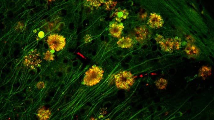 Nowe badania wskazują na nieznane dotychczas źródło choroby Alzheimera