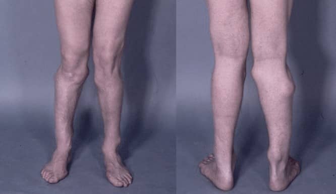 Deformacje kości u pacjenta cierpiącego na HME /Fot. Wikimedia Commons
