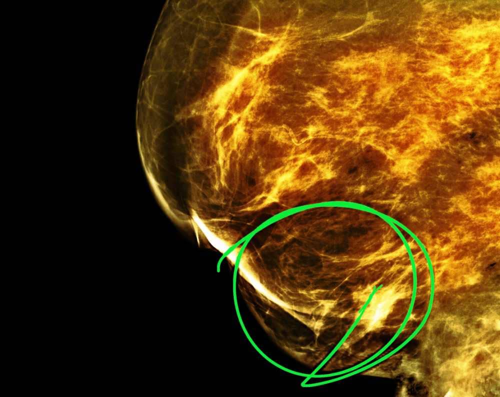 Rak piersi najczęściej diagnozowanym nowotworem na świecie. Stoi za tym kilka czynników