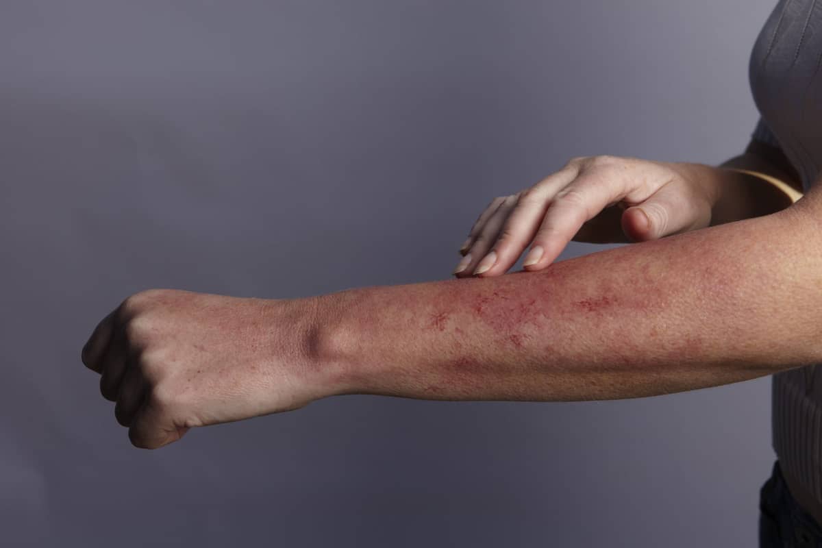 Koniec z AZS u dzieci? Dupilumab to pierwszy skuteczny lek biologiczny