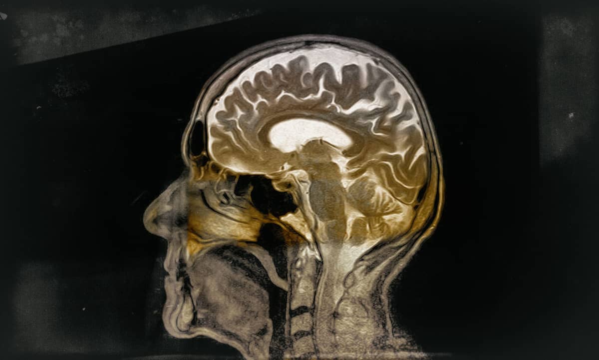 Co się dzieje w mózgu osób z ADHD?
