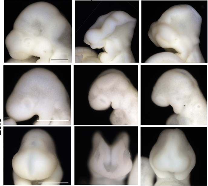 Jak powszechnie stosowany lek wpływa na wady wrodzone? Mini-mózgi dostarczają odpowiedzi