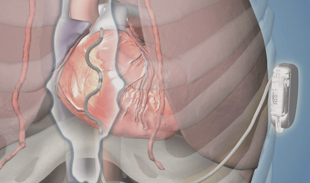 Ratunek dla najciężej chorych. Pierwszy taki kardiowerter-defibrylator na rynku