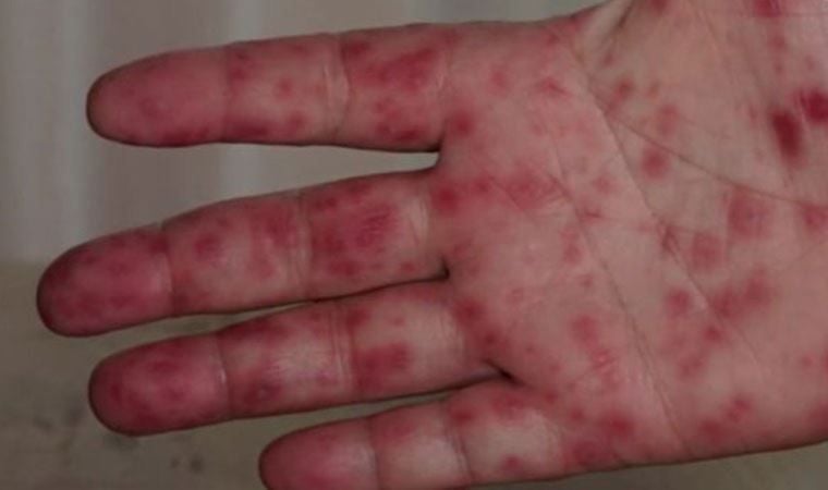 “Pomidorowa grypa” szaleje w Indiach. Eksperci dostrzegają pewien schemat