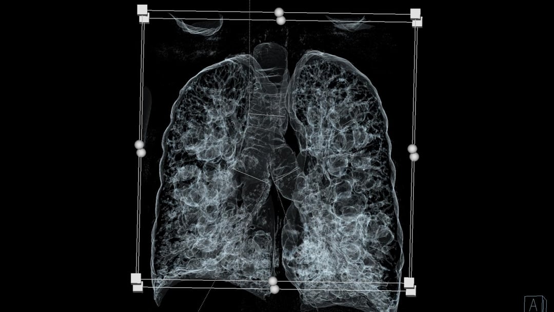 To dopiero druga taka operacja na świecie. Przeprowadzili ją Polacy