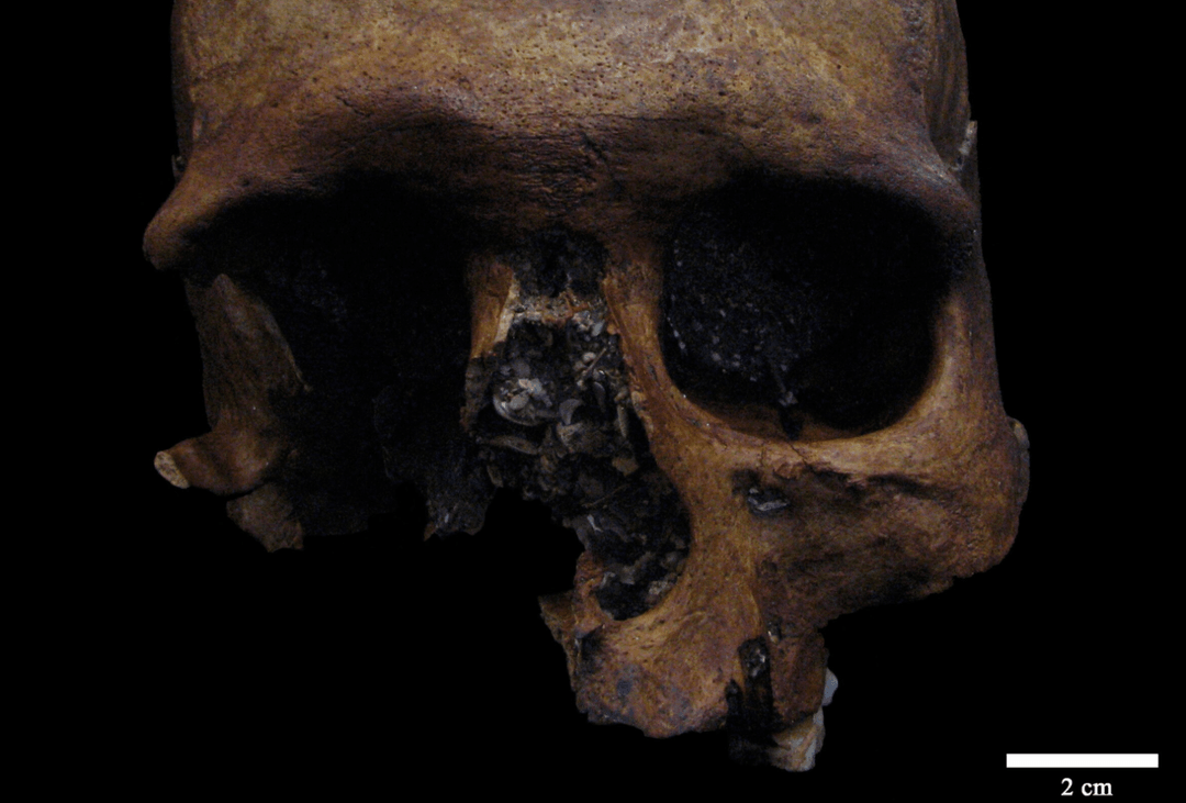 Ludzie w starożytności wcale nie byli zdrowsi od nas. Odkryto czaszkę człowieka, który cierpiał na nietypowego guza