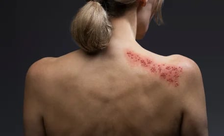 Neuralgia popółpaścowa. Takiego bólu nie życzyłabym najgorszemu wrogowi