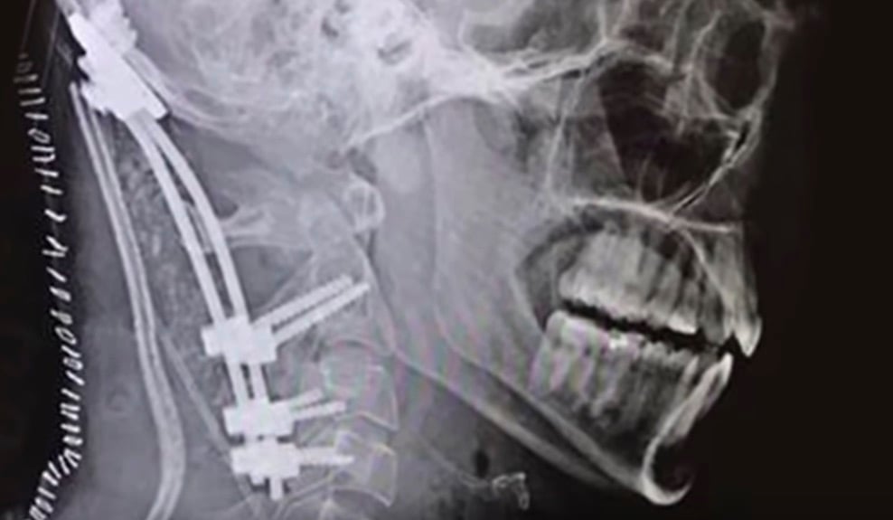 TO się nazywa mieć szczęście! Przetrwał raka oraz “wewnętrzną dekapitację”