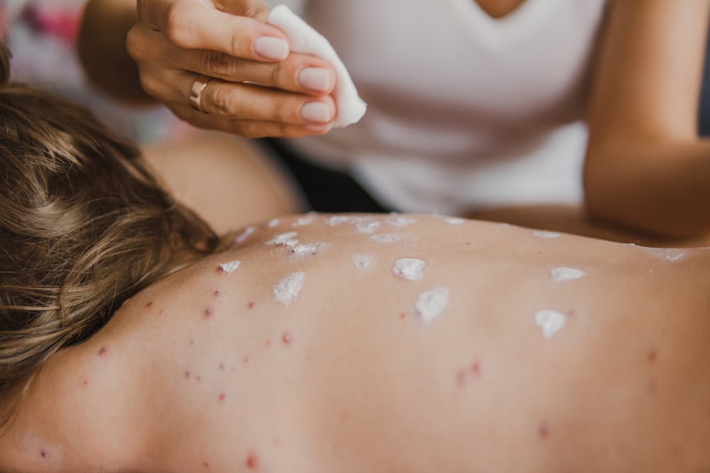 Rekordowa liczba przypadków odry. Dzieci antyszczepionkowców same szukają pomocy