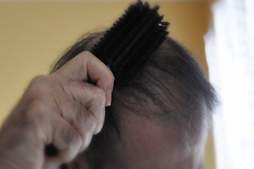 Skuteczny sposób hamujący wypadanie włosów – odkrycie polskich naukowców