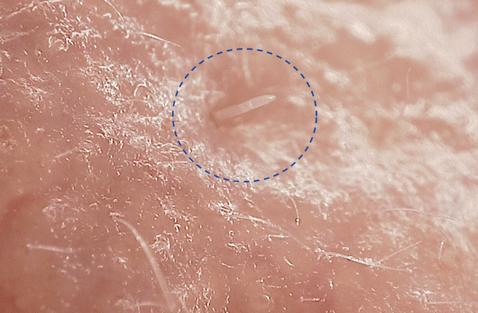 Demodex folliculorum /Fot. University of Reading
