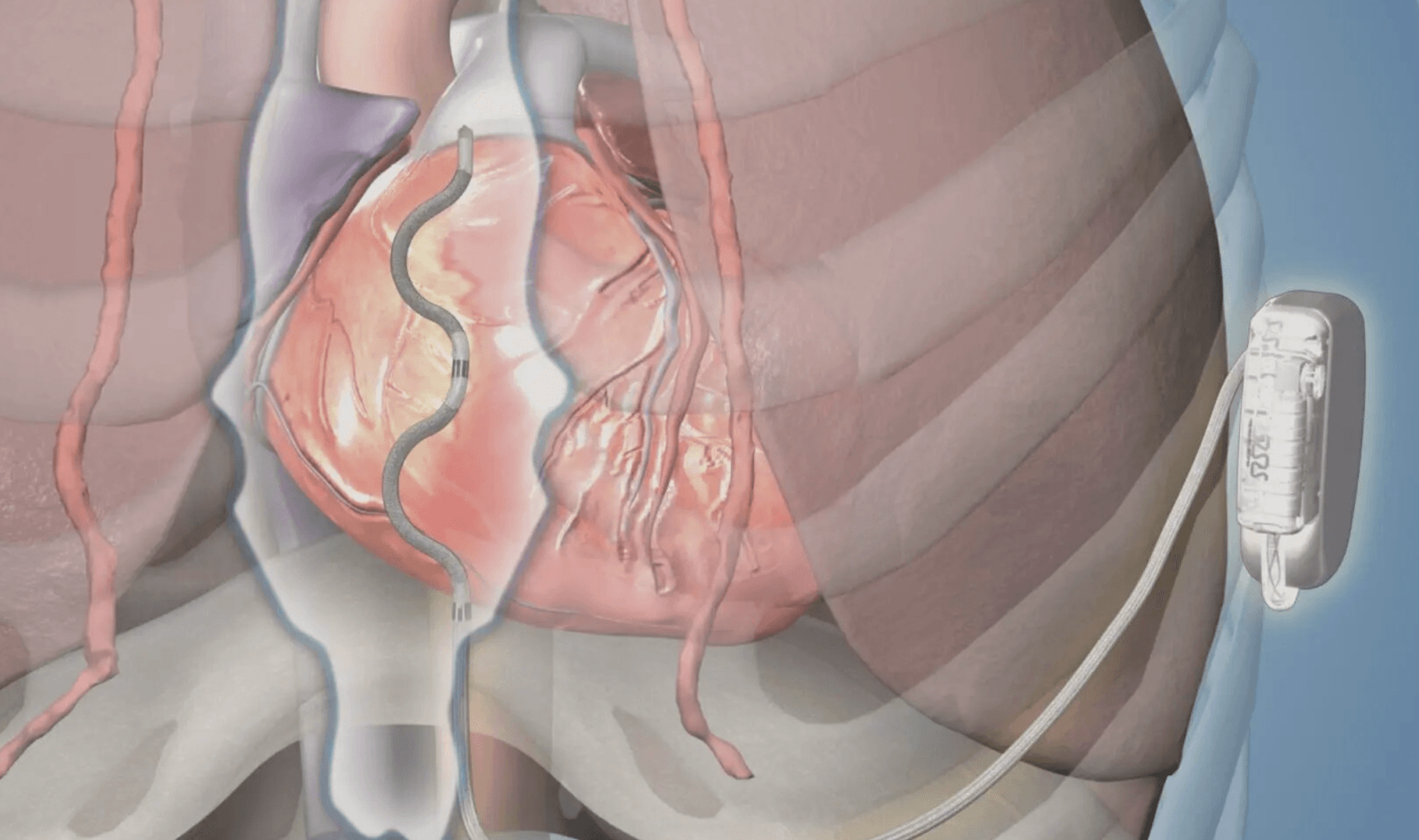ICD stworzony przez Mayo Clinic jest jedyny w swoim rodzaju /Fot. Mayo Clinic
