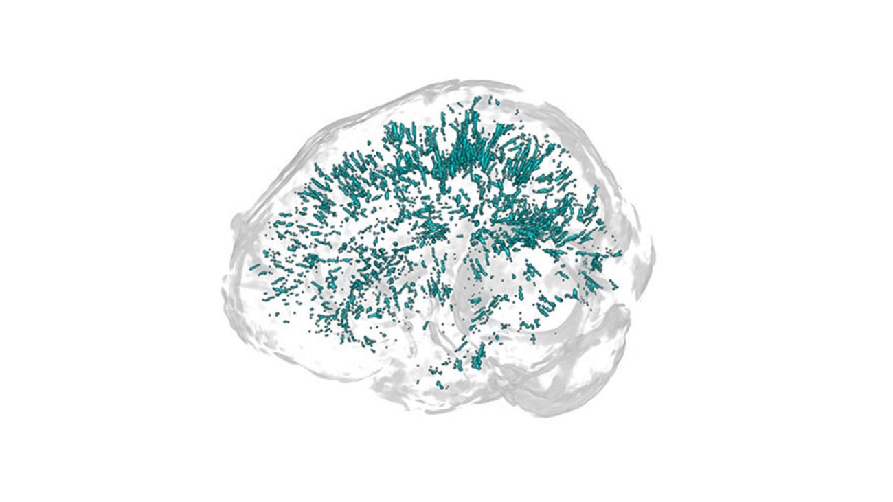 Przyczyna migren odkryta? Naukowcy zwrócili uwagę na zmiany w mózgu