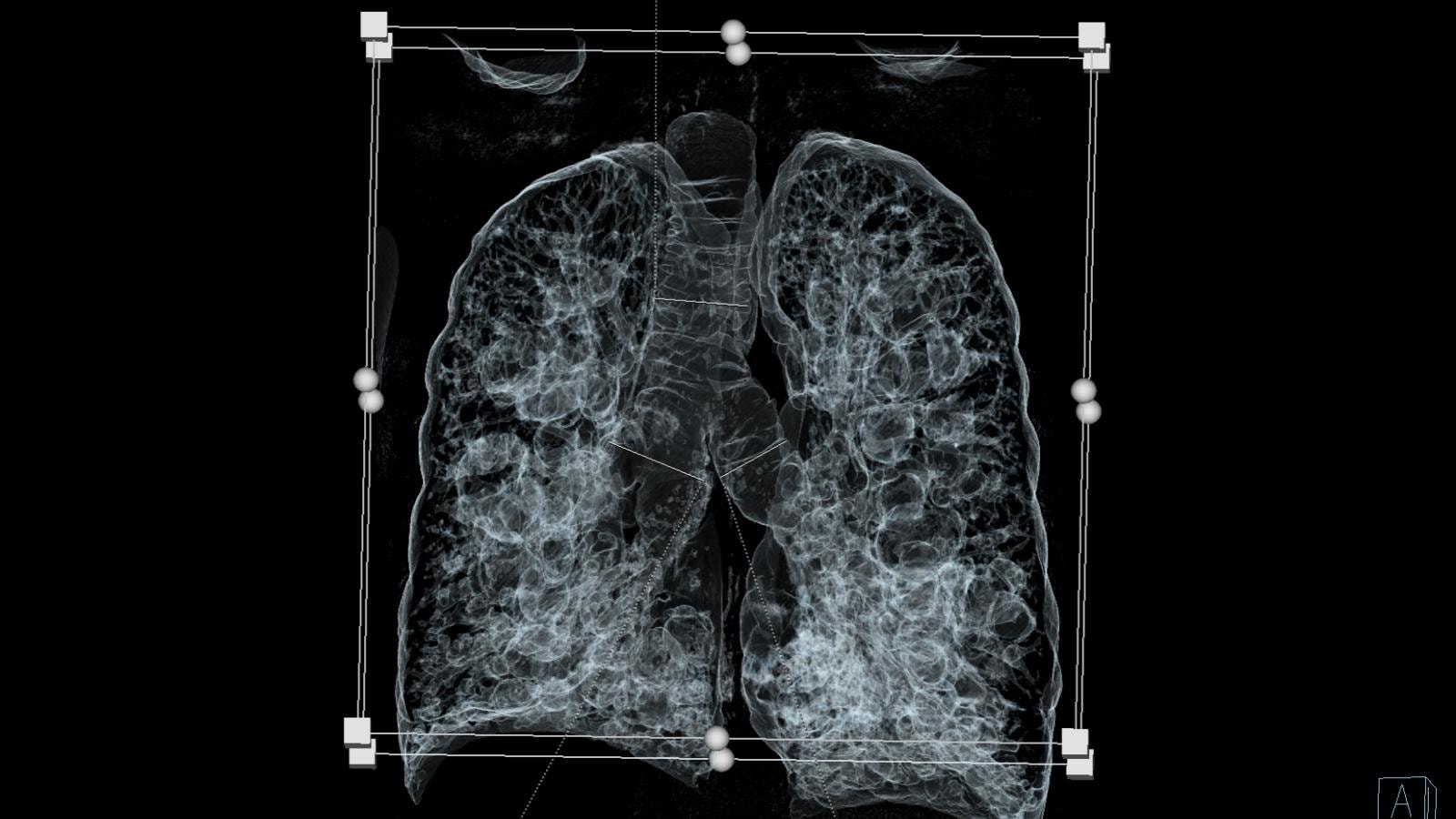 Pierwsza w Polsce i druga taka operacja na świecie – przeprowadzona w SCCS /Fot. SCCS
