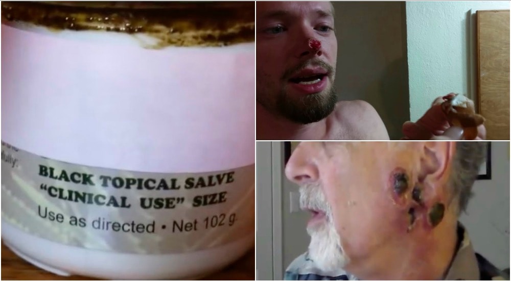 Czy “czarna maść” leczy raka?