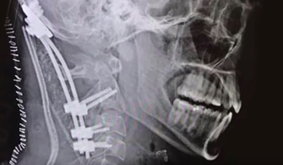 TO się nazywa mieć szczęście! Przetrwał raka oraz “wewnętrzną dekapitację”