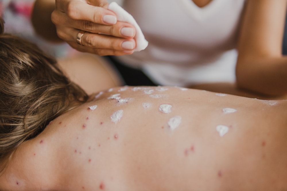 Rekordowa liczba przypadków odry. Dzieci antyszczepionkowców same szukają pomocy