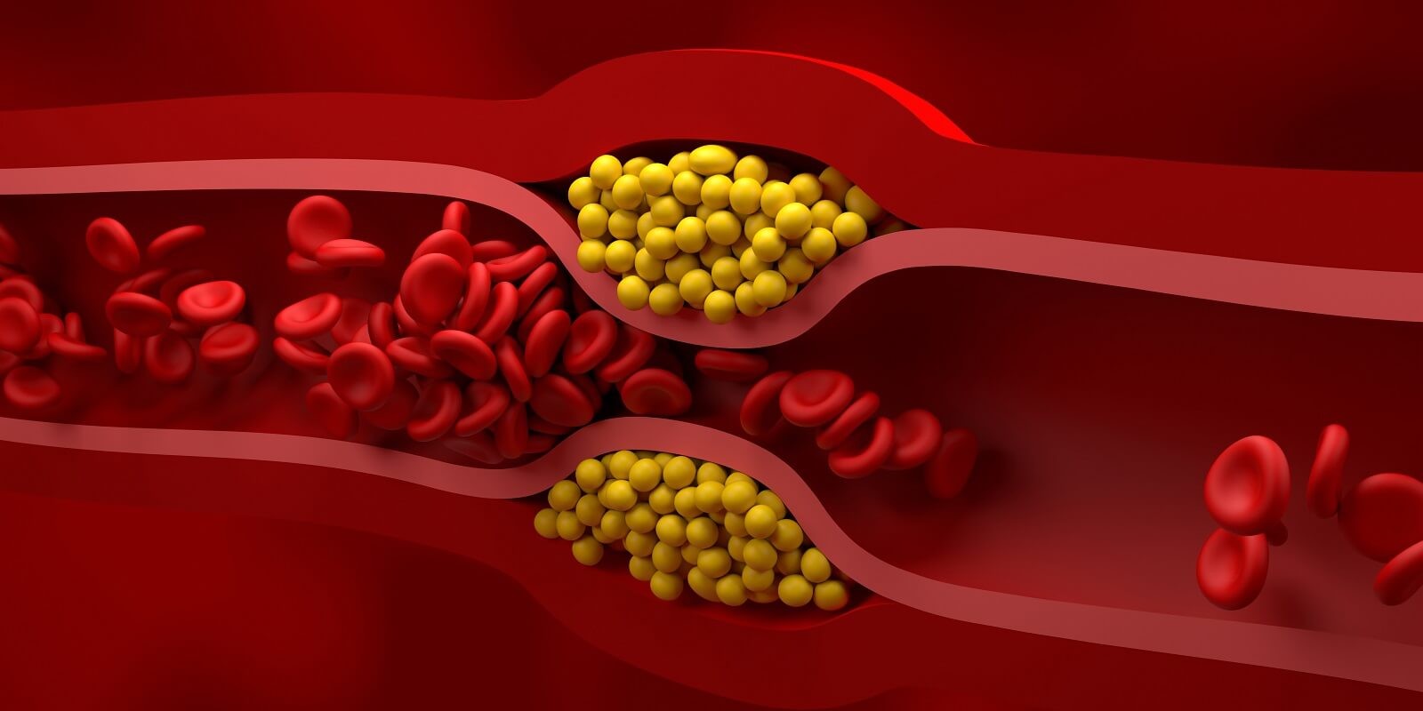 Cholesterol dosłownie zatyka tętnice /Fot. Imperial Center Family Medicine
