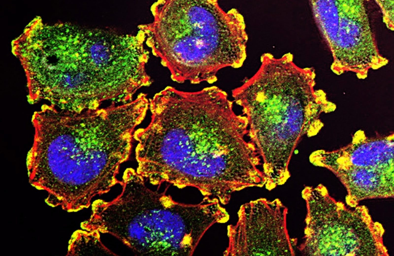 Komórki czerniaka &#8211; zdjęcie poglądowe /Fot. National Cancer Institute
