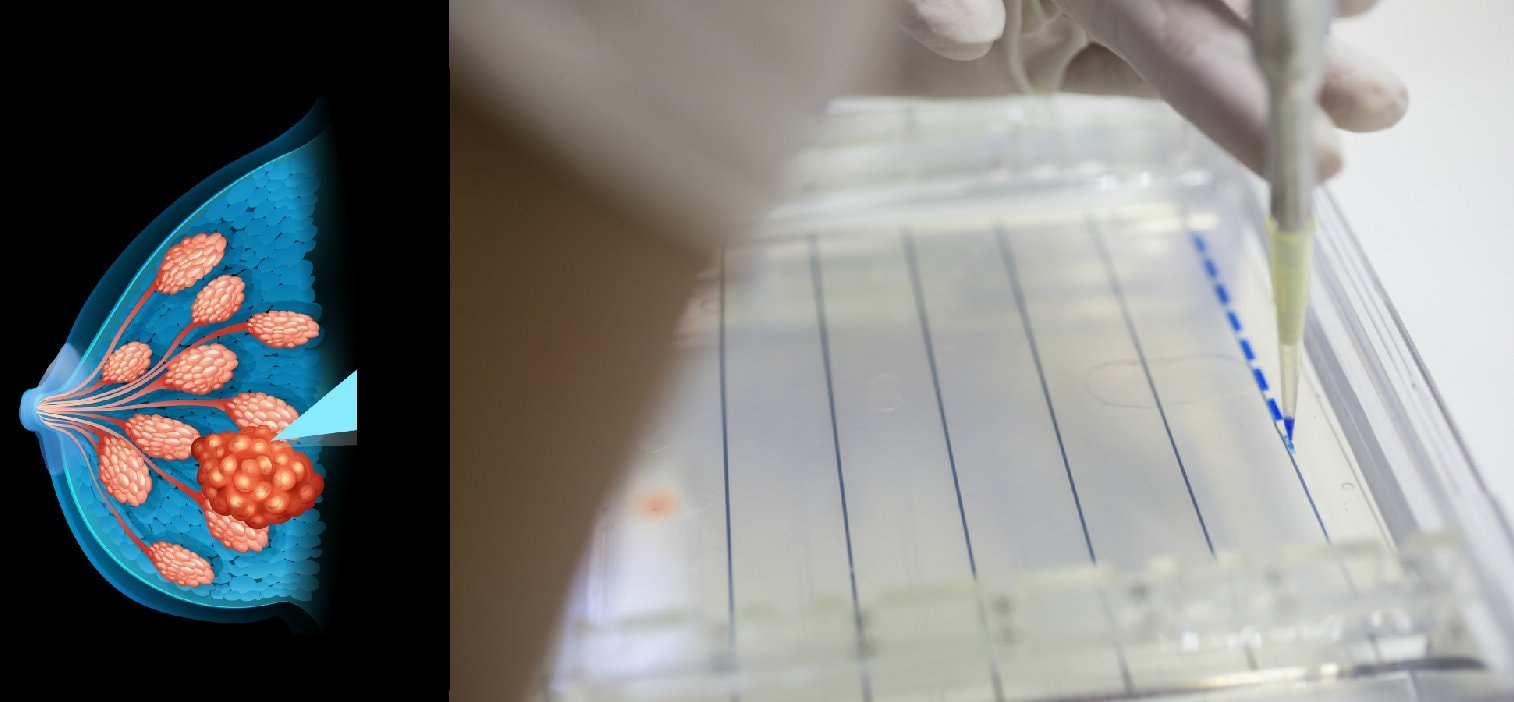 Odkryto 72 nowe mutacje genetyczne odpowiedzialne za raka piersi