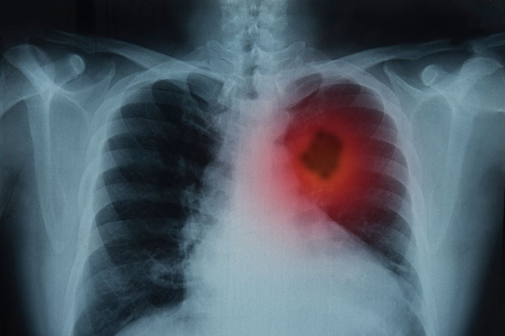Czy nasz układ odpornościowy zabije raka? Immunoterapia skuteczna w wielu odmianach nowotworu