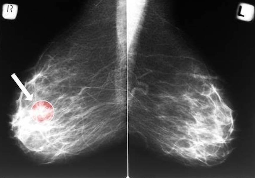 Aż 70% kobiet z rakiem piersi może uniknąć chemioterapii. Wystarczy odpowiednio wczesna diagnoza