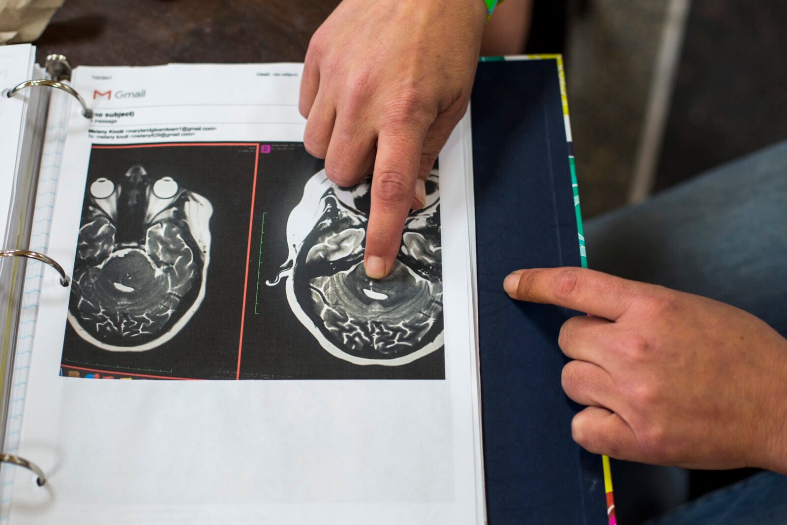 Wirus polio może być dobry dla ludzkości? Bada się go jako broń na raka