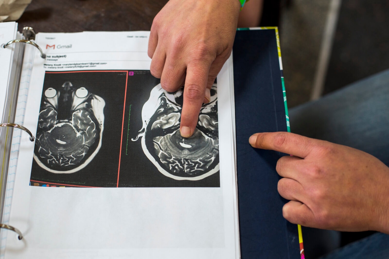 Wirus polio może być dobry dla ludzkości? Bada się go jako broń na raka