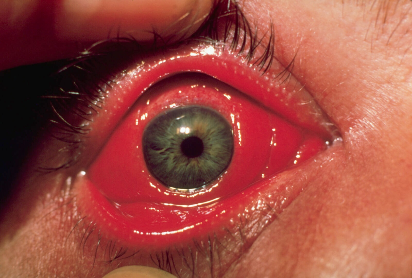 Rekordowa liczba zachorowań na choroby weneryczne. “Będziemy potrzebowali nowych terapii”