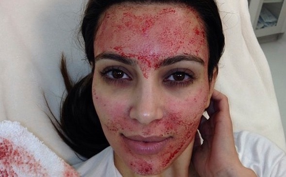 Wampirzy lifting. Zabieg promowany przez celebrytów śmiertelnie groźny