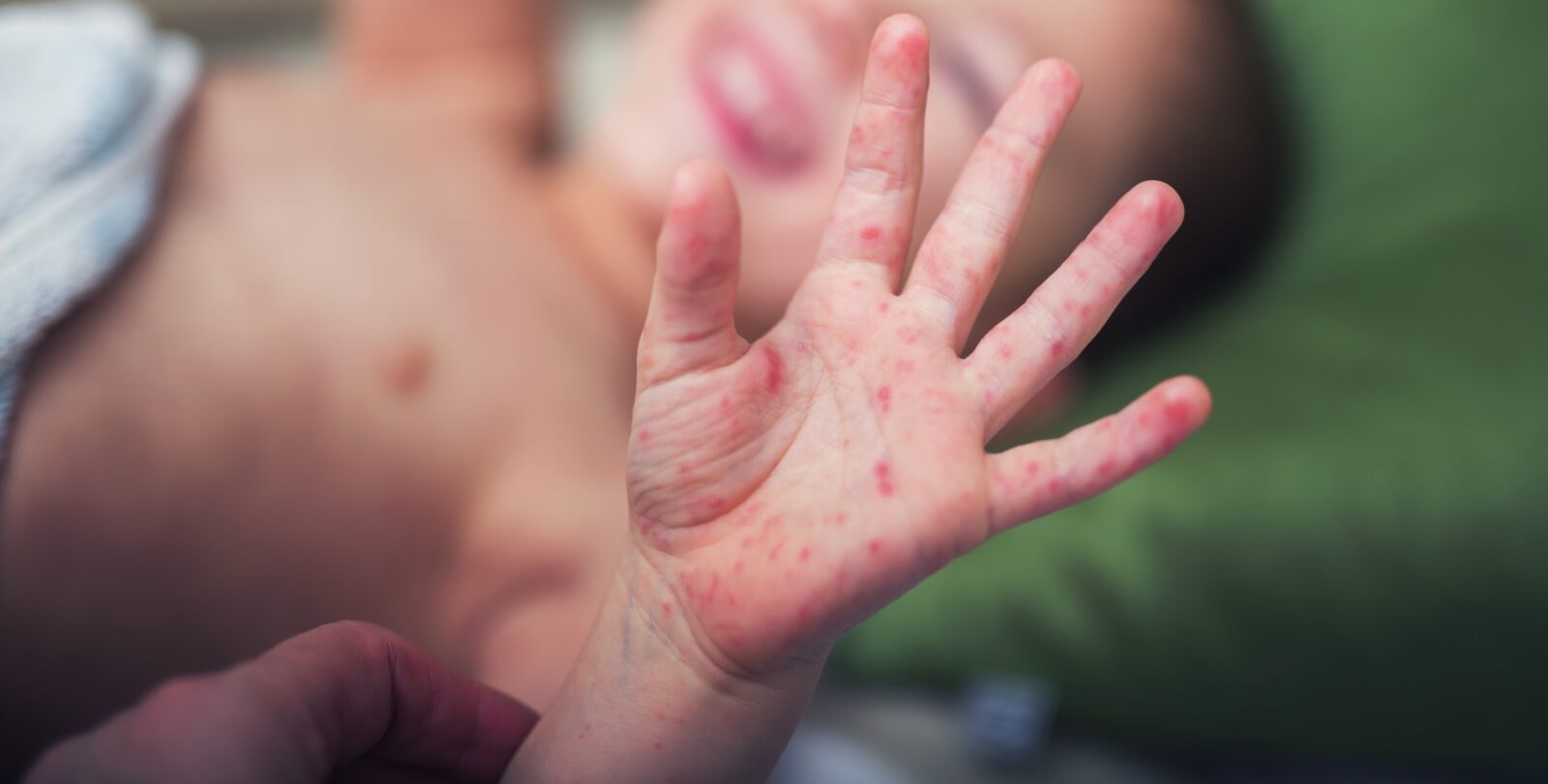 Już 37 osób zmarło w tym roku z powodu odry. Możemy “podziękować” antyszczepionkowcom