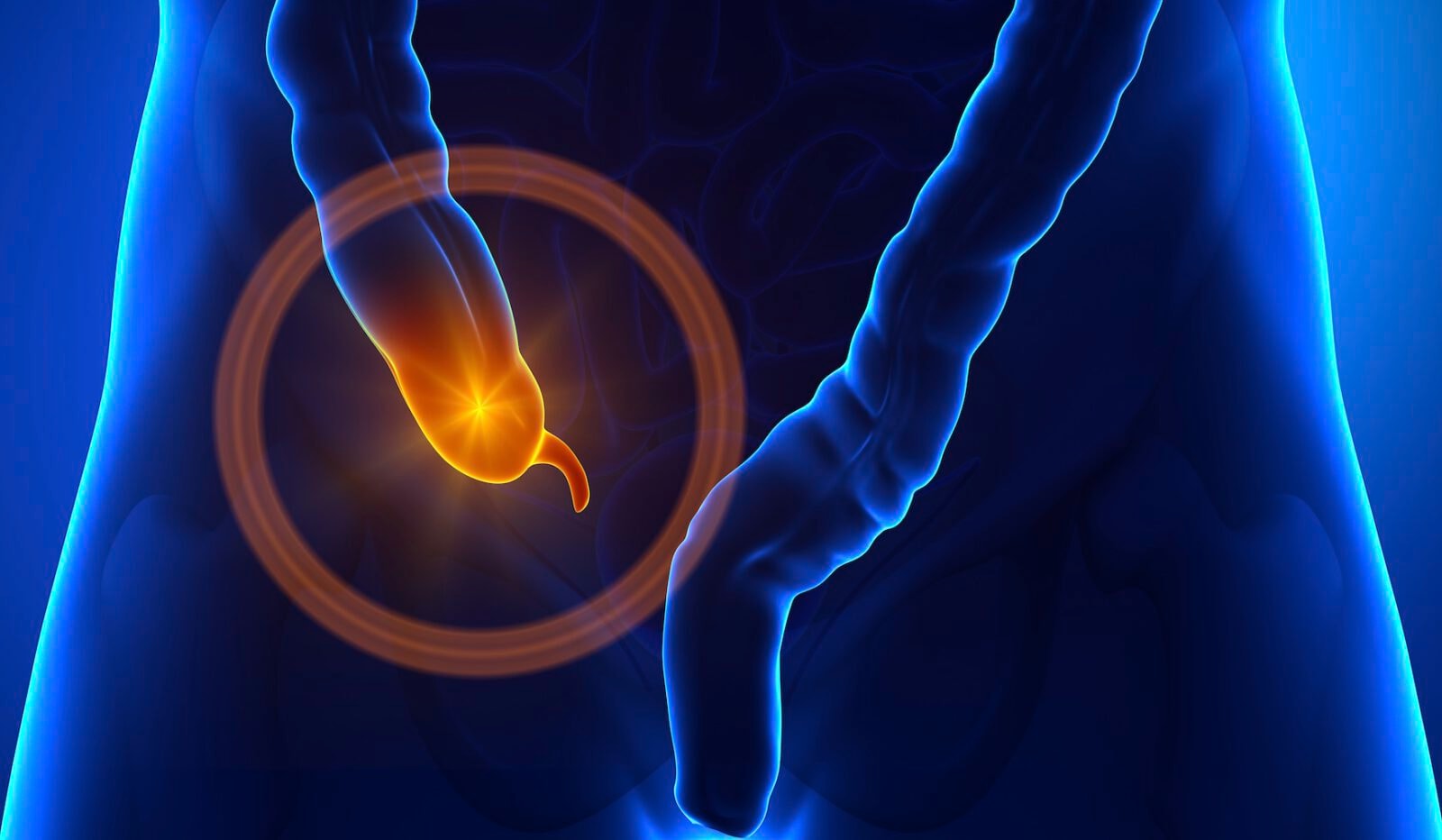 Jest związek między wyrostkiem robaczkowym a chorobą Parkinsona. Nowe badanie