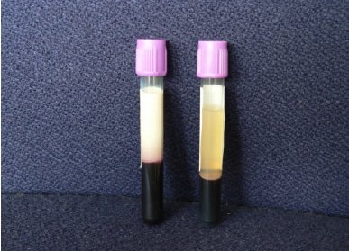 “Mleczna krew” niezwykle rzadki stan, który fascynuje lekarzy. Ostatnio w Niemczech