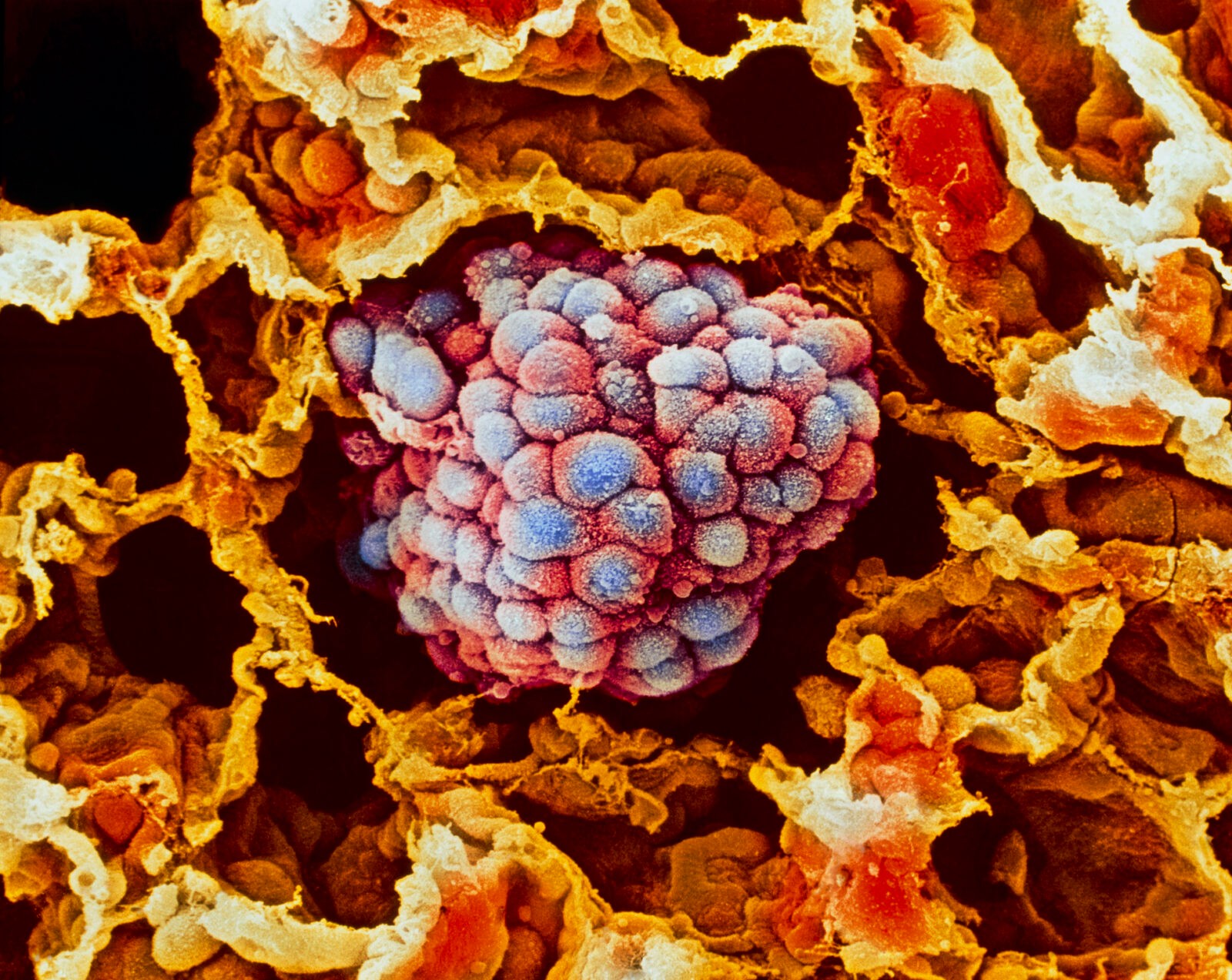 Naukowcy odkryli, jak zatrzymać komórki rakowe. “To ważny krok na drodze do zrozumienia nowotworów”