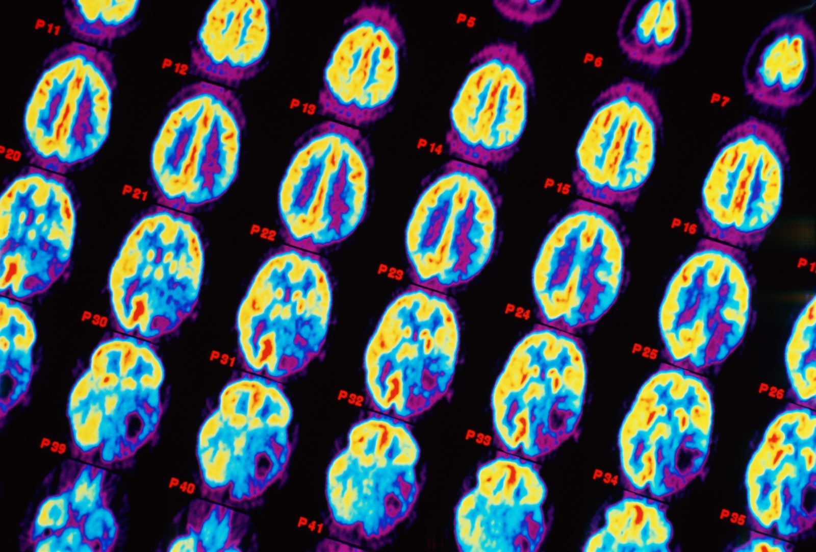 Tomograf zamiast biopsji. Polacy zapowiadają przełom w medycynie