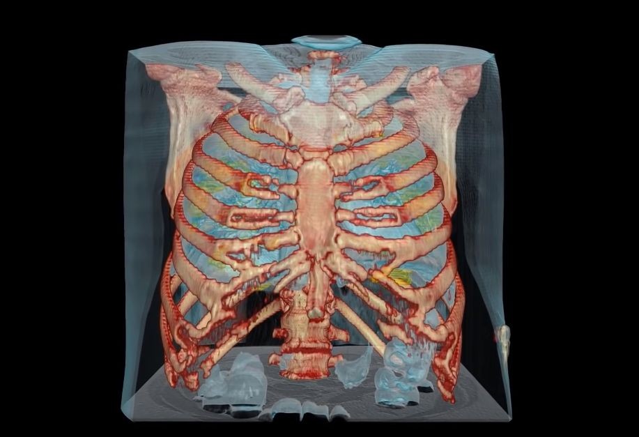 Pokazano trójwymiarowy obraz płuc zniszczonych koronawirusem [WIDEO]