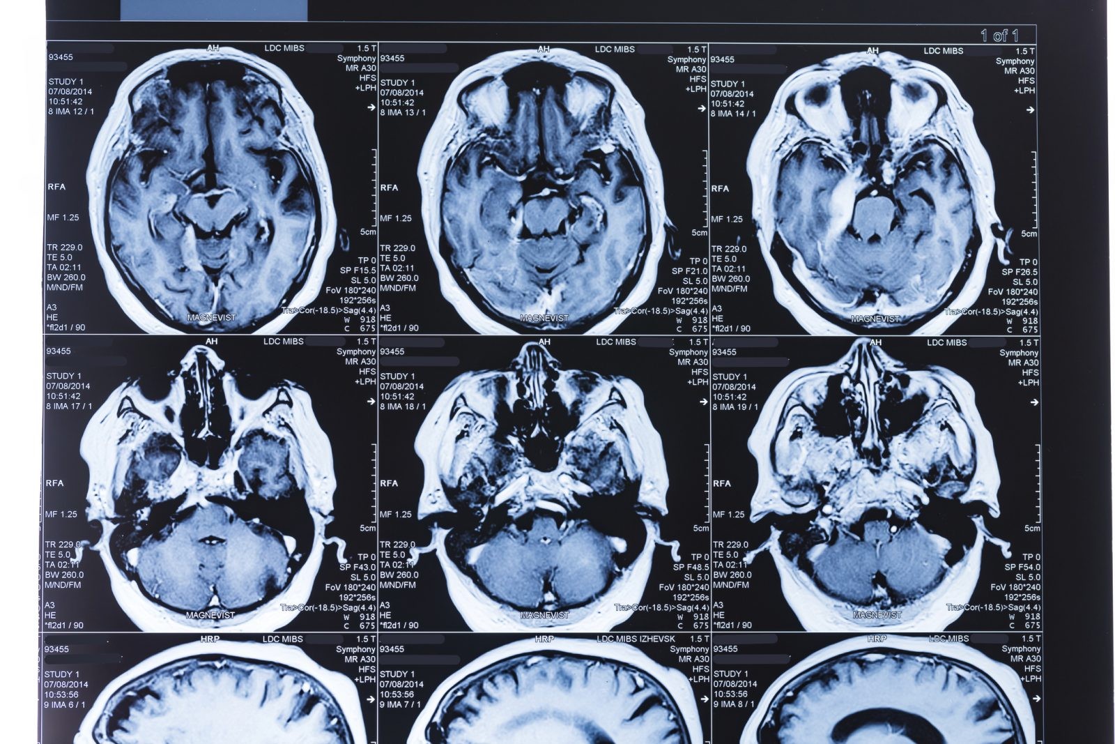 Choroba Alzheimera rozwija się w mózgu przez ok. 30 lat, ale u niektórych zmiany pojawiają się wcześniej
