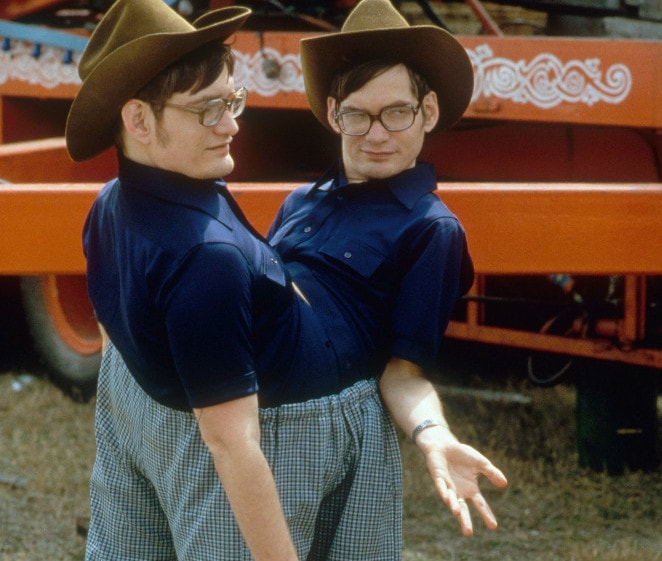 Przeżyli 68 lat twarzą w twarz, zrośnięci od mostka do pachwiny. Najdłużej żyjąca para bliźniąt syjamskich