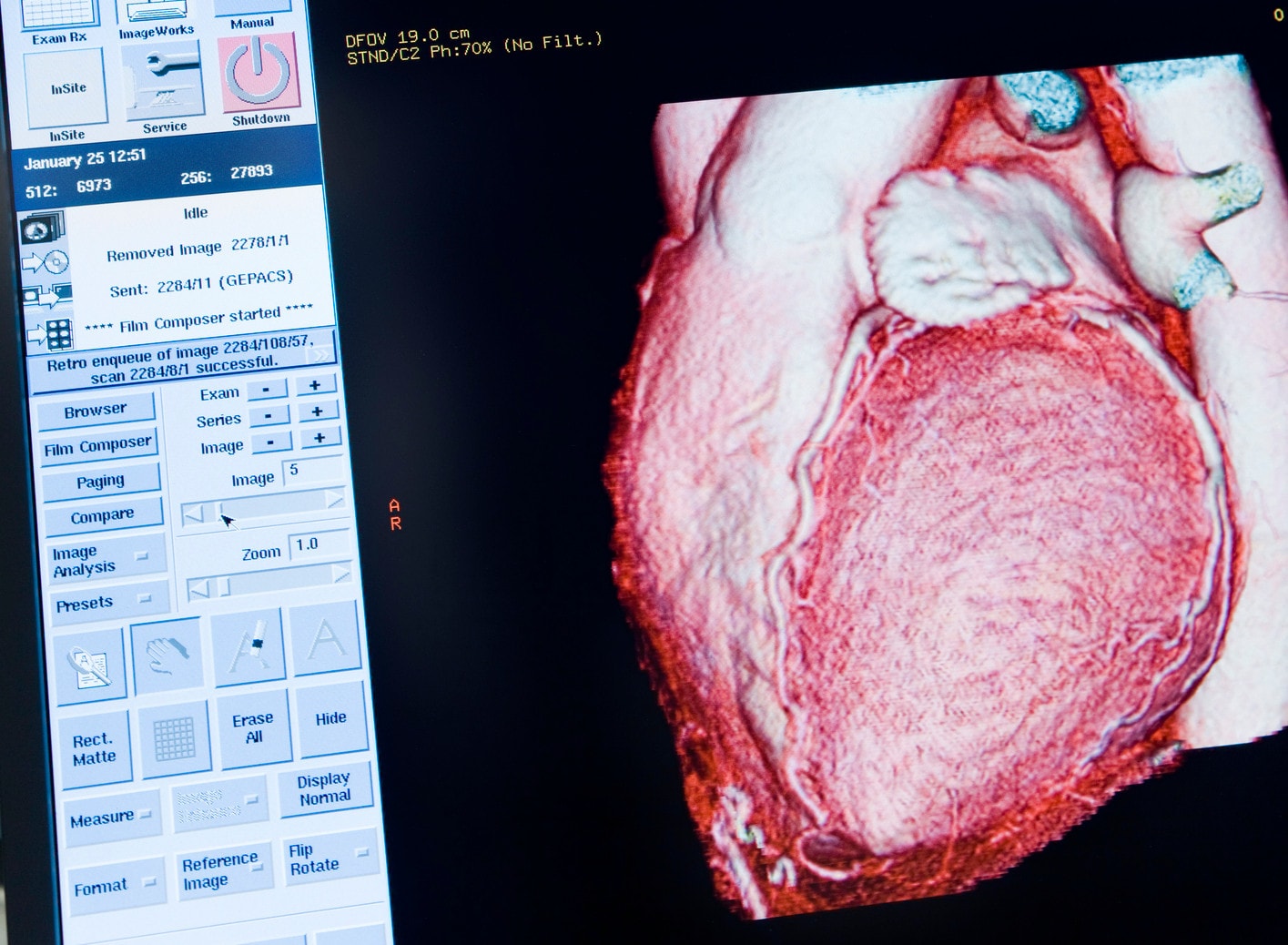 Koronawirus może uszkodzić serce. U połowy badanych wykryto zaburzenia