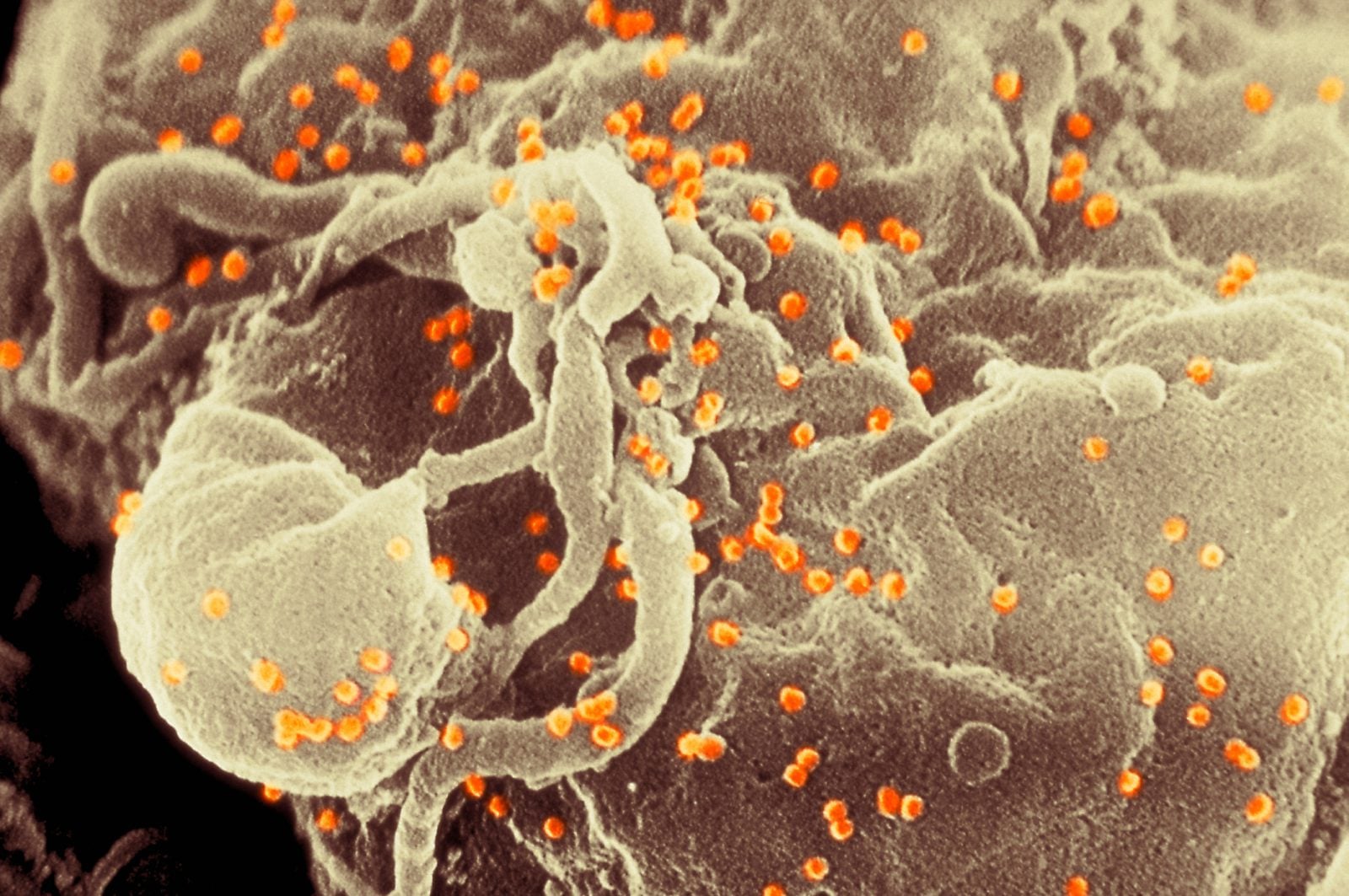 Układ odpornościowy pacjenta sam pokonał HIV. Pierwszy taki przypadek