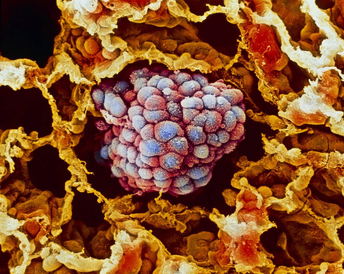 Komórki rakowe mogą wejść w stan hibernacji, żeby uniknąć chemioterapii. Niepokojące wyniki badań