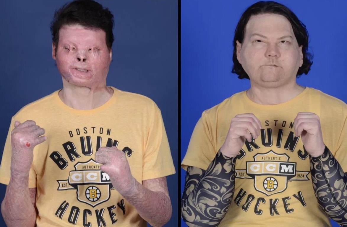 Pierwszy w historii udany podwójny przeszczep rąk i twarzy