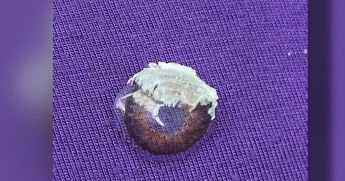 Niebezpieczna pomyłka: kobieta zamiast kropli do oczu użyła kleju