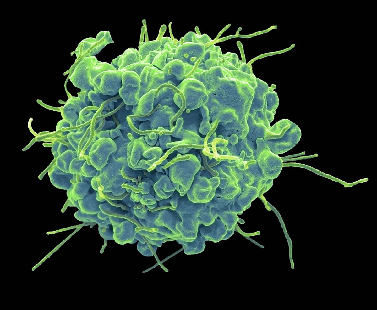 Czy nowy lek na raka będzie oparty na żelazie? Tajemnicze zjawisko ferroptozy