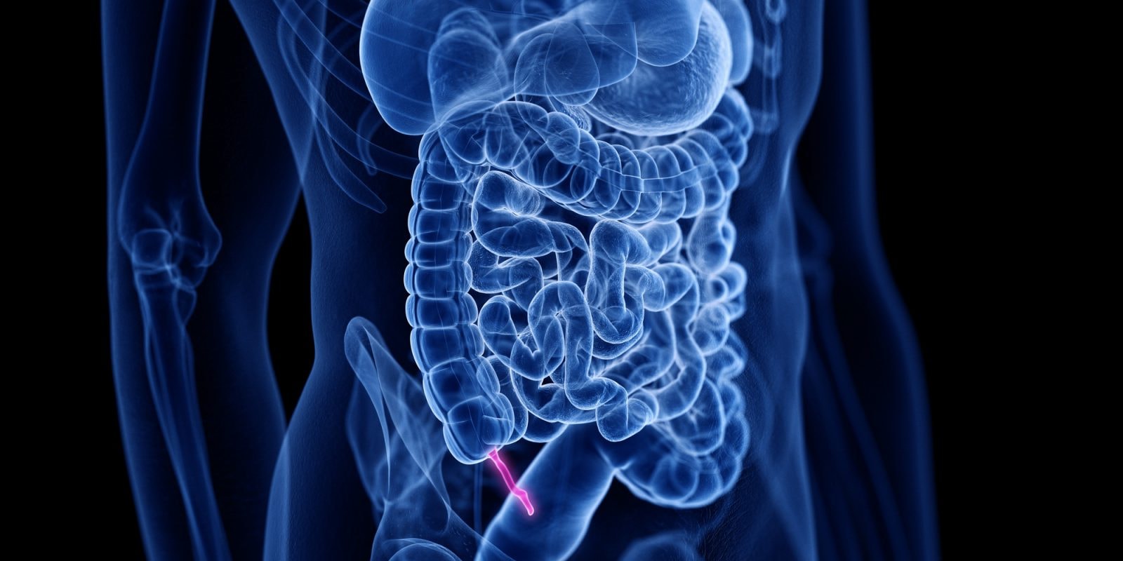 Zapalenie wyrostka robaczkowego należy najpierw leczyć antybiotykami. Nowe zalecenia dla chirurgów