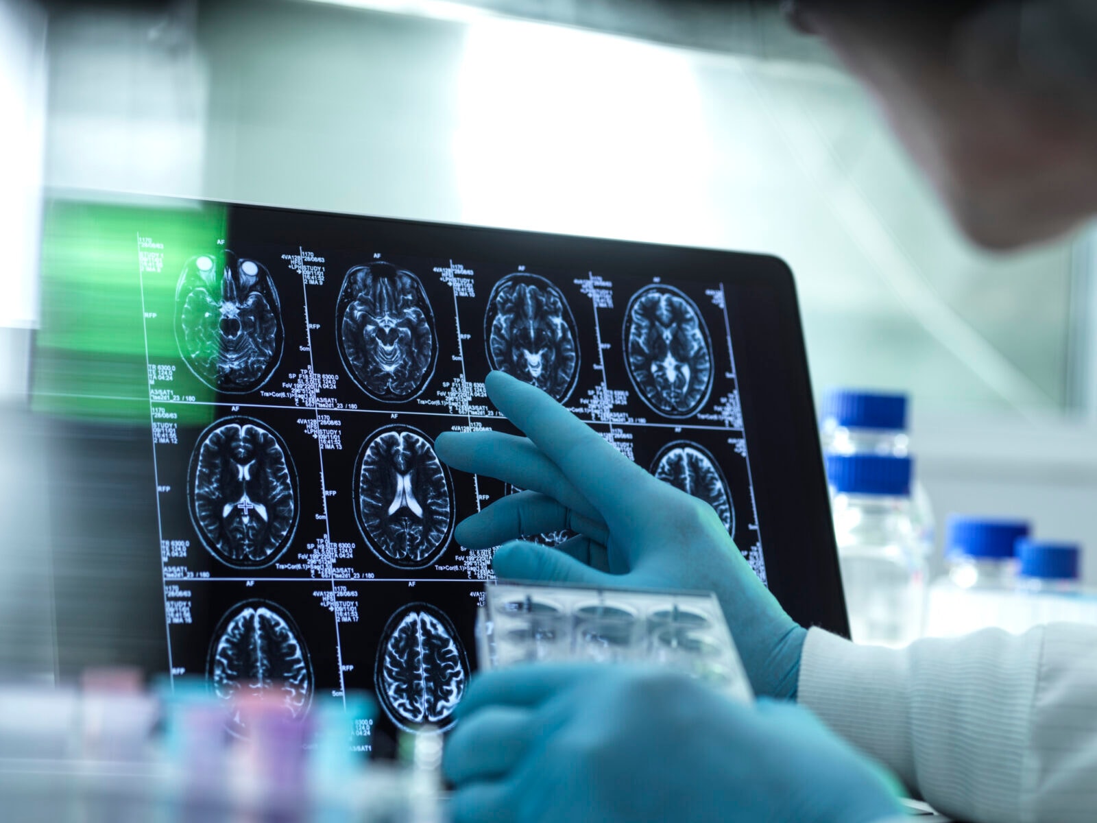 Tajemnicza choroba mózgu w Kanadzie. Nikt nie wie, co powoduje „zespół neurologiczny o nieznanym pochodzeniu”