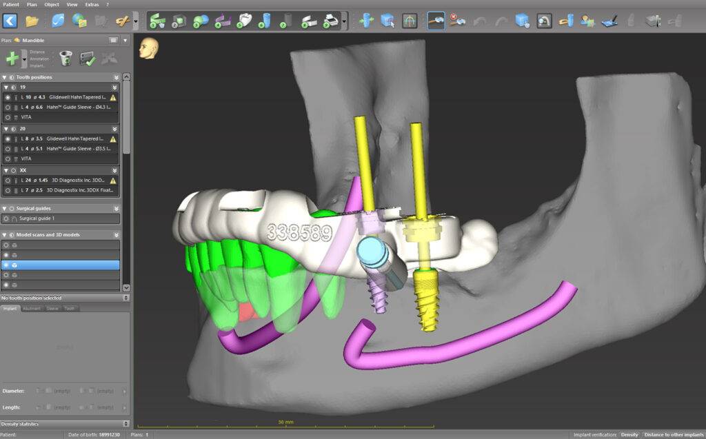 Nowoczesna implantologia: jak rozwój technologii wpływa na stomatologię