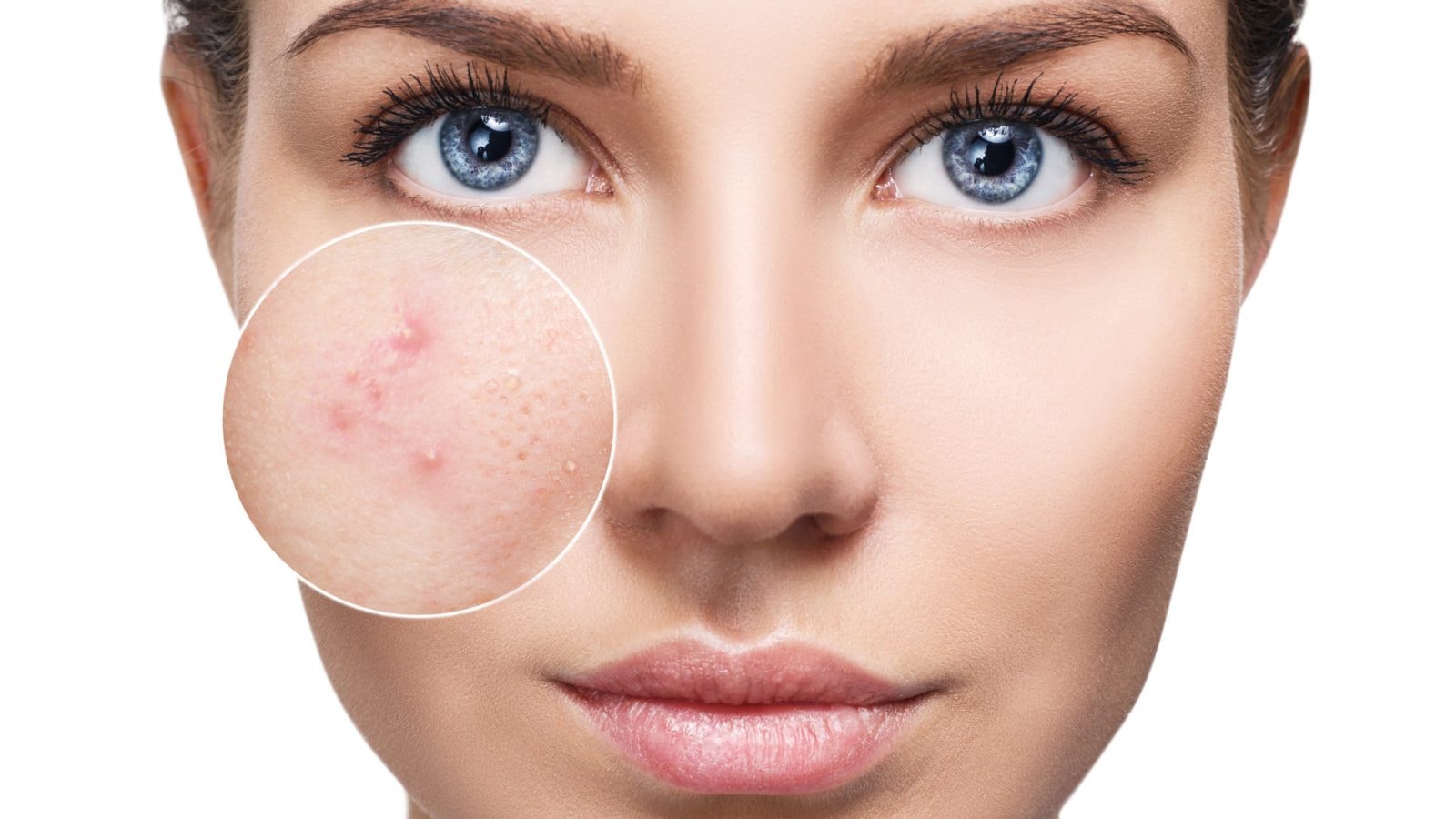 Skąd się bierze trądzik? Naukowcy trafili na cenną wskazówkę