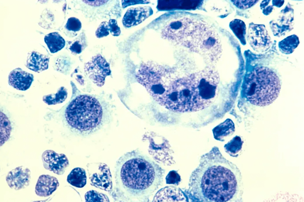 Komórki chłoniaka /Fot. National Cancer Institute
